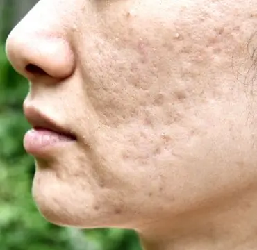 Acne Scar Treatment