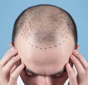 Hair Transplant