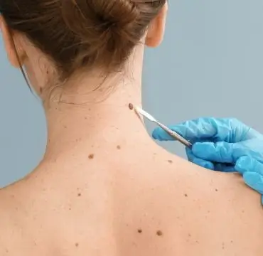 Skin Tag Removal Treatment